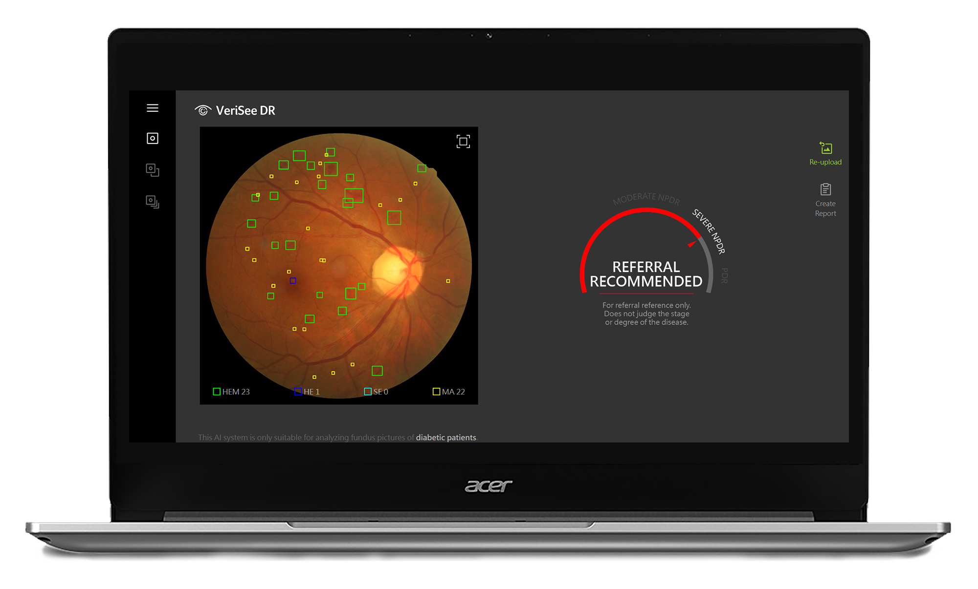 new feature en Acer Medical Inc. ร่วมกับ 4 โรงพยาบาลทดลองใช้งาน Verisee DR ซอฟต์แวร์วินิจฉัยภาวะเสี่ยงของโรคเบาหวานขึ้นจอประสาทตา เพิ่มช่องทางการเข้าถึงบริการทางการแพทย์ได้อย่างรวดเร็ว